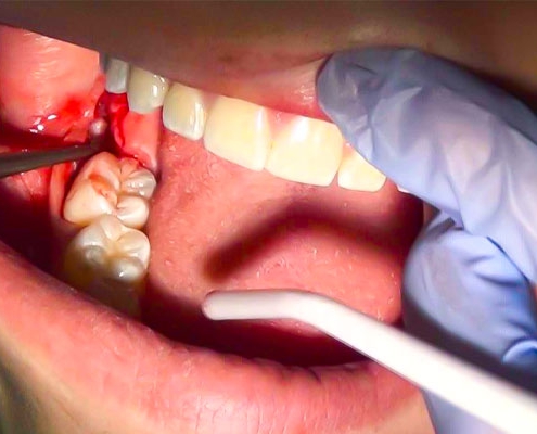 مراقبت های بعد از کشیدن دندان