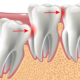دندان نهفته چیست و با آن چه باید کرد؟